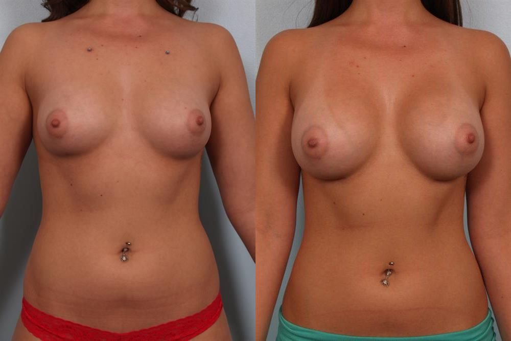 Breast Augmentation 242