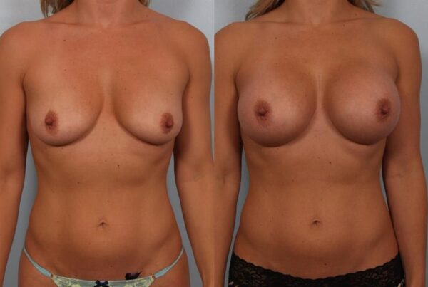 Breast Augmentation 243