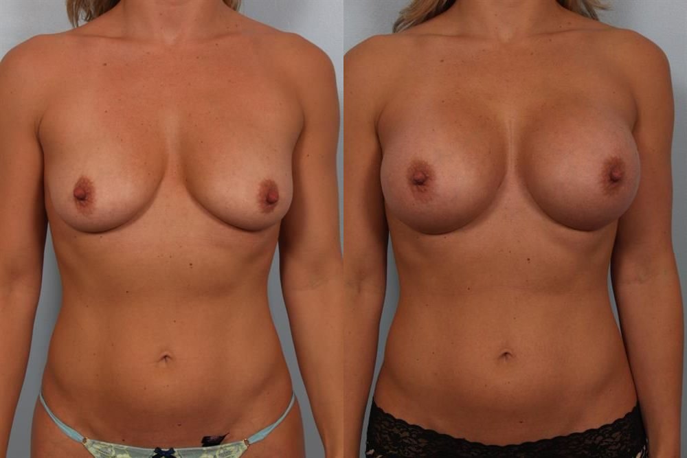 Breast Augmentation 243