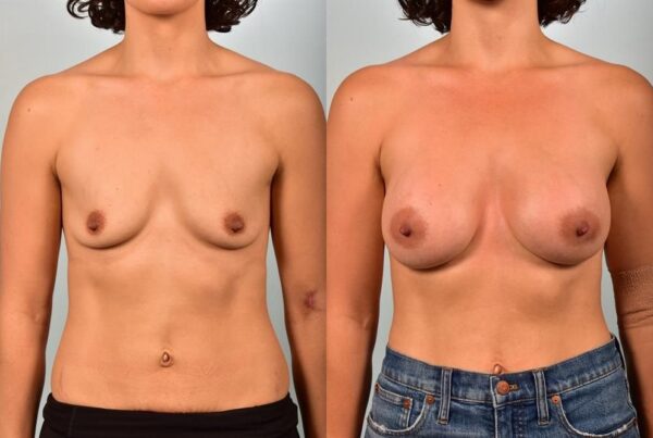 Breast Augmentation 244