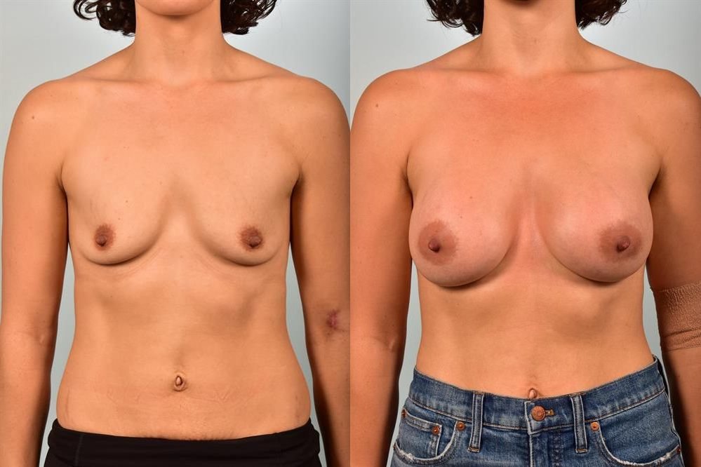 Breast Augmentation 244