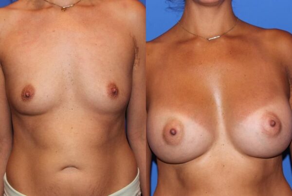 Breast Augmentation 245