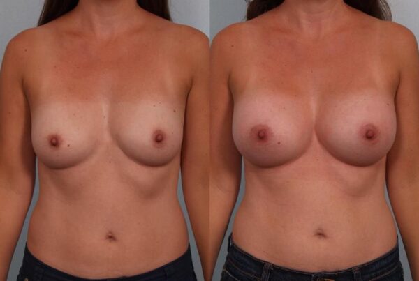 Breast Augmentation 246