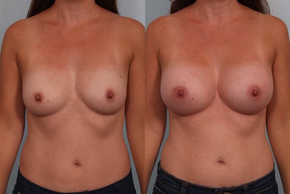 Breast Augmentation 246