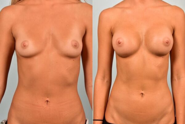 Breast Augmentation 247