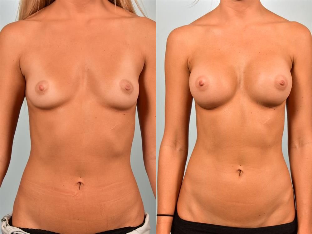 Breast Augmentation 247