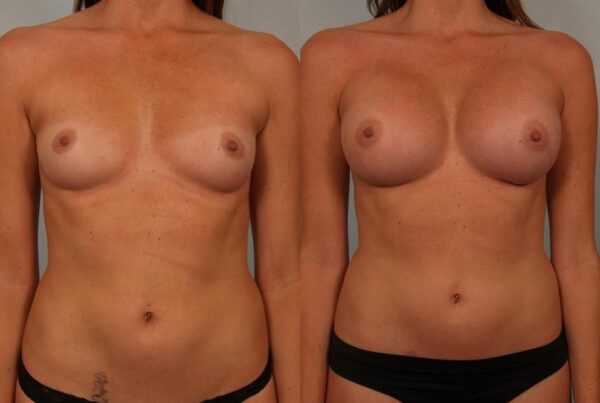 Breast Augmentation 248