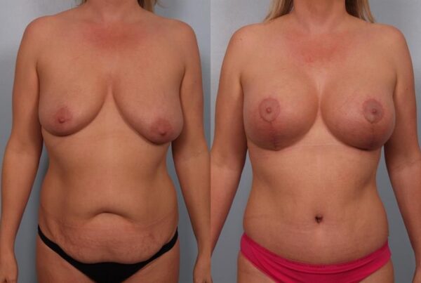 Breast Augmentation 249