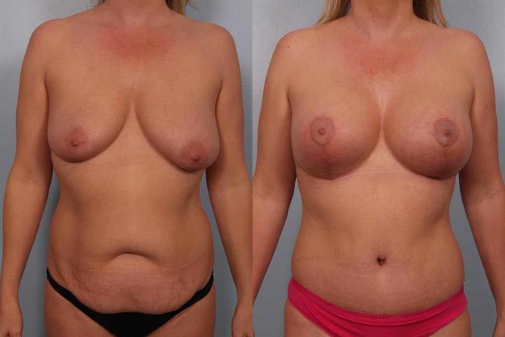 Breast Augmentation 249