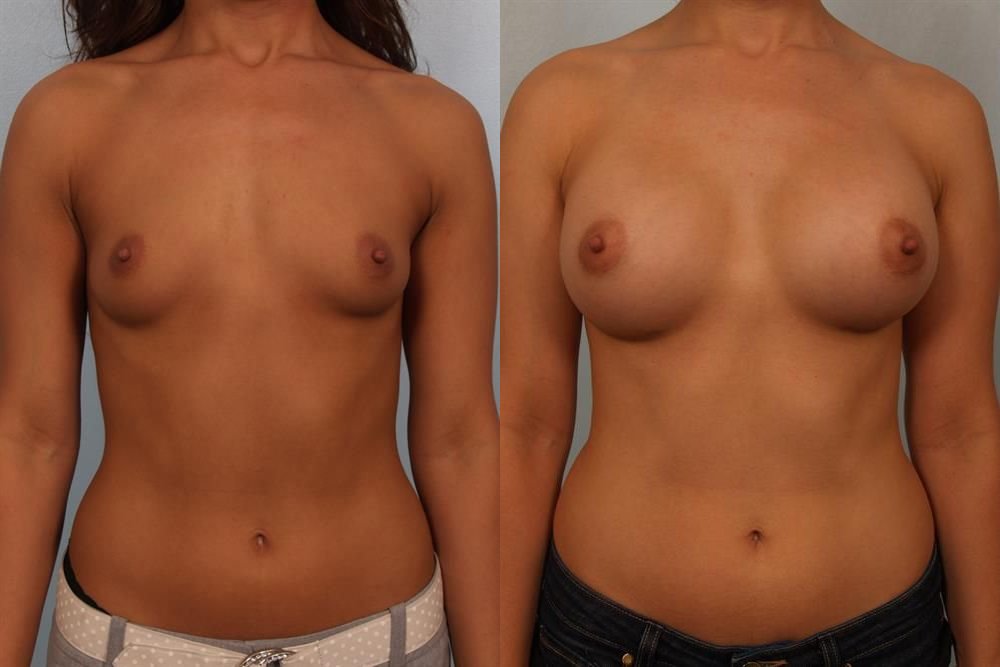 Breast Augmentation 25