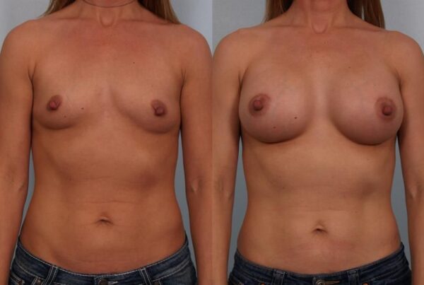 Breast Augmentation 250