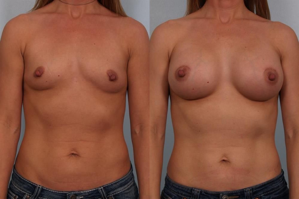 Breast Augmentation 250