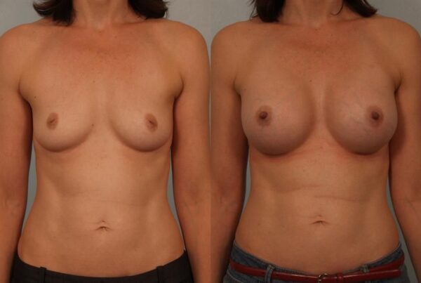 Breast Augmentation 251