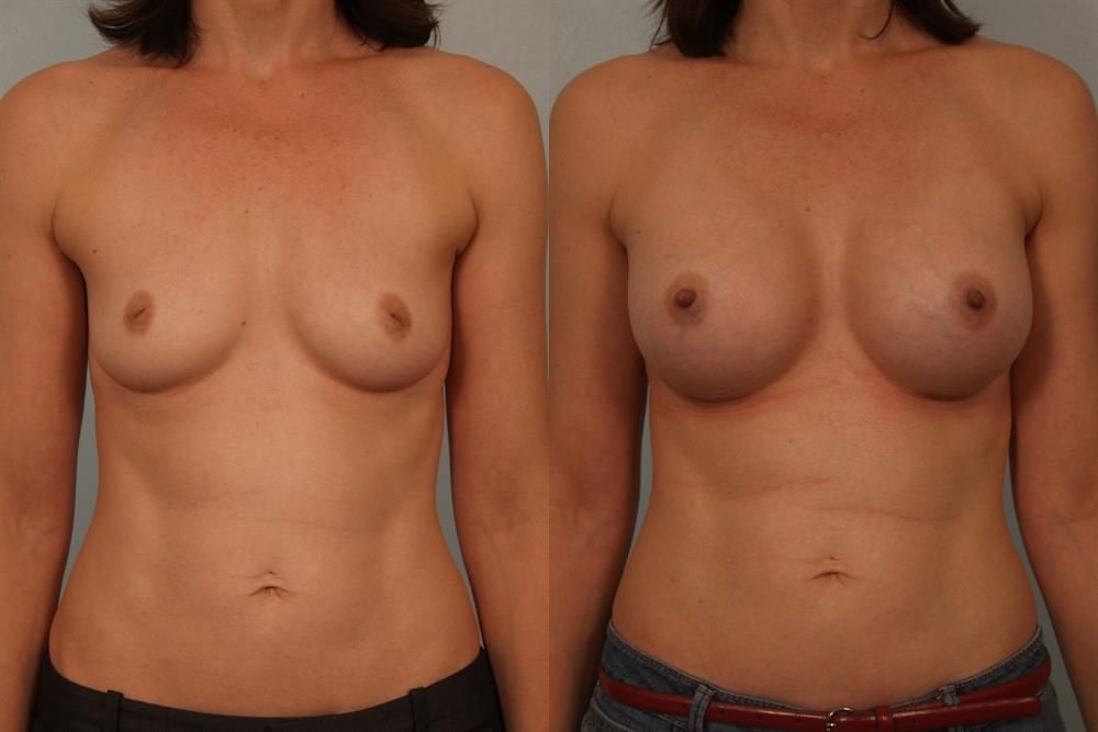 Breast Augmentation 251
