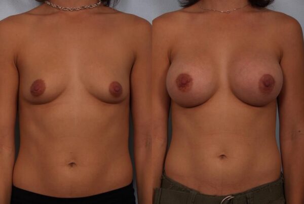 Breast Augmentation 252