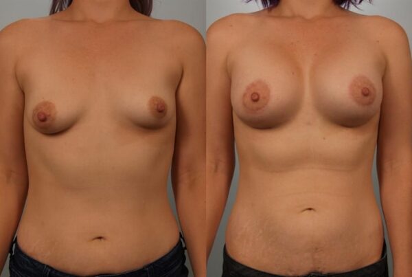 Breast Augmentation 253
