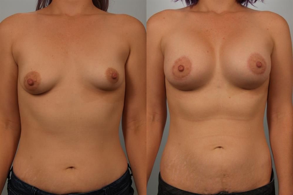 Breast Augmentation 253