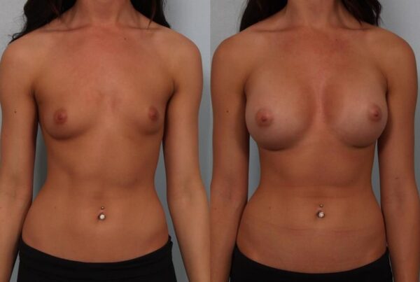 Breast Augmentation 254