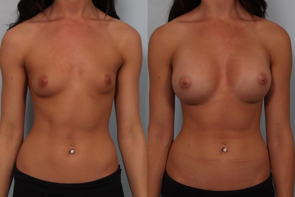 Breast Augmentation 254