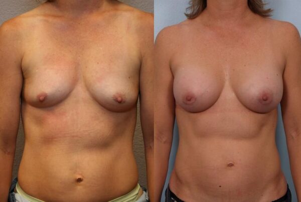 Breast Augmentation 255