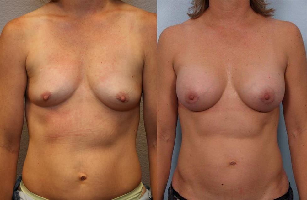 Breast Augmentation 255