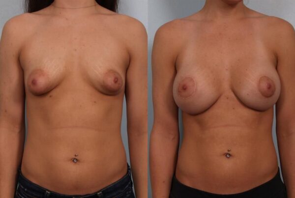 Breast Augmentation 256