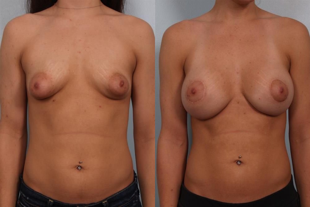 Breast Augmentation 256