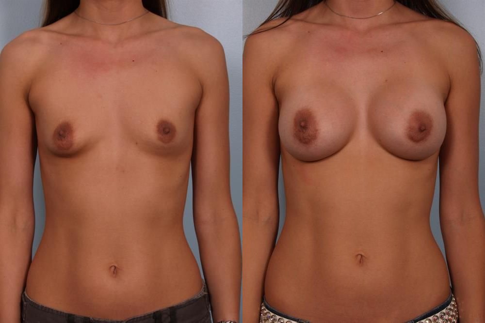 Breast Augmentation 257