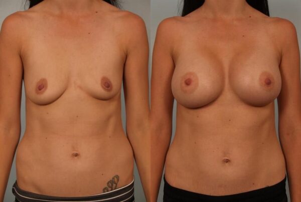 Breast Augmentation 258