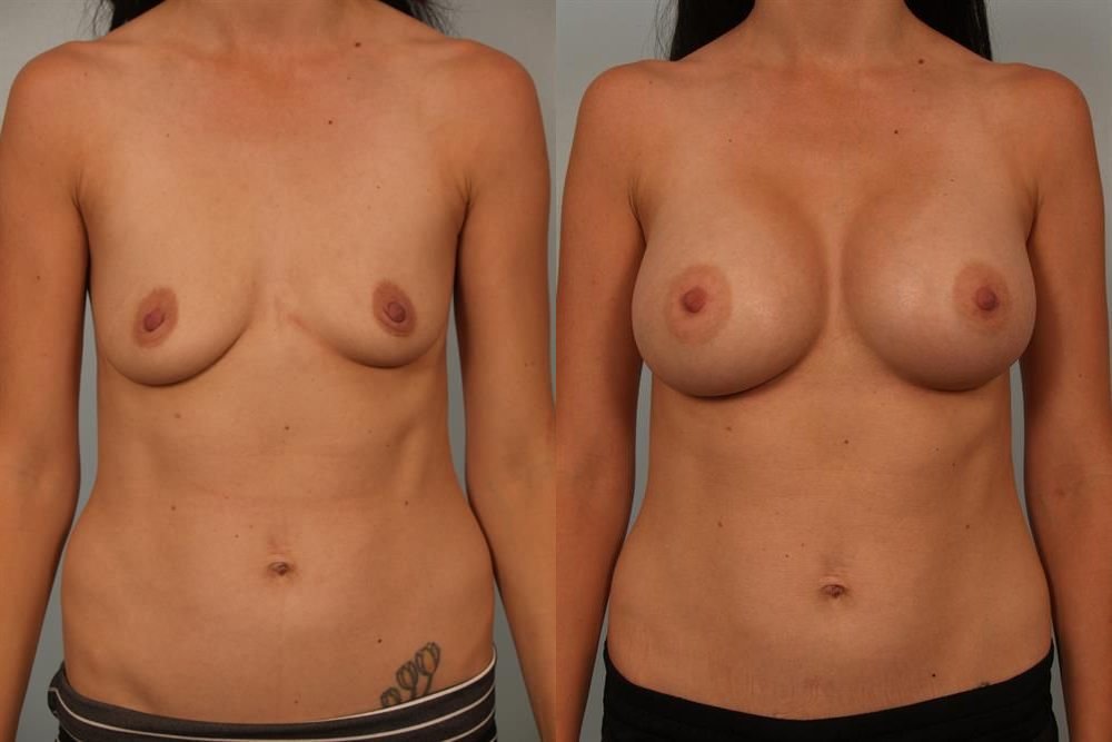 Breast Augmentation 258
