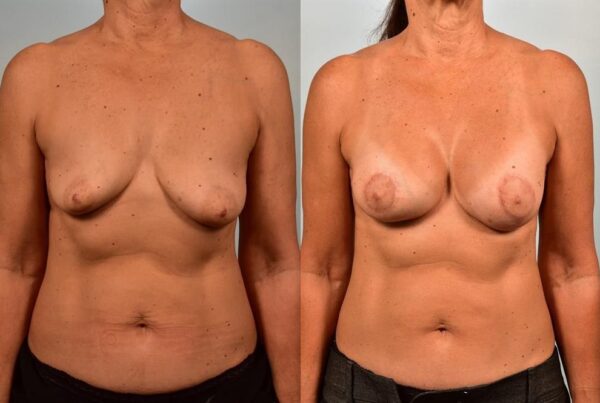 Breast Augmentation 26