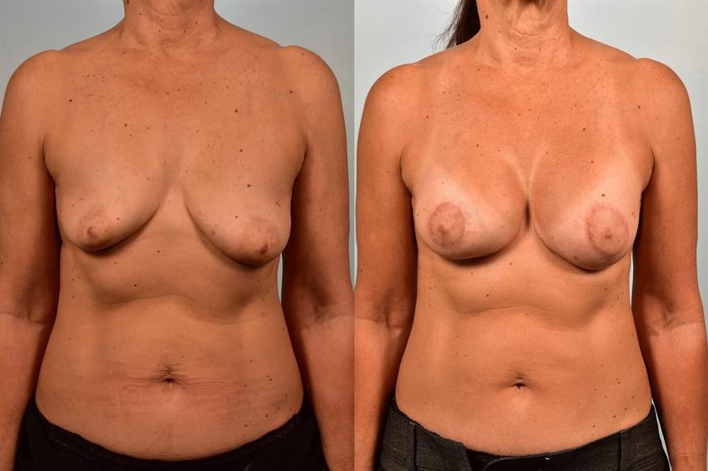 Breast Augmentation 26