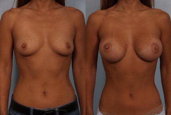 Breast Augmentation 260