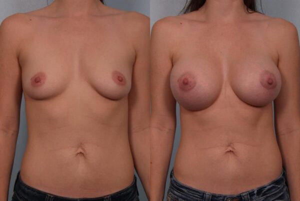 Breast Augmentation 261