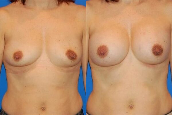 Breast Augmentation 262
