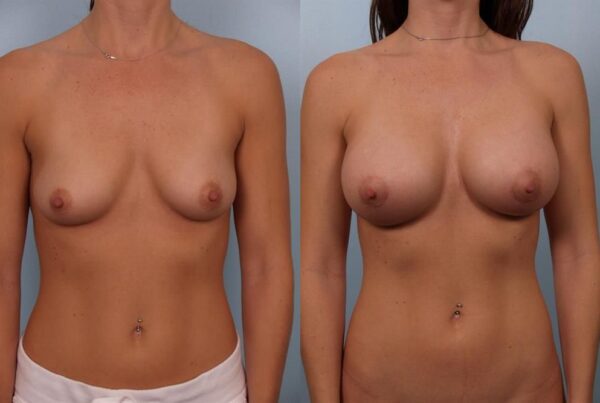 Breast Augmentation 263