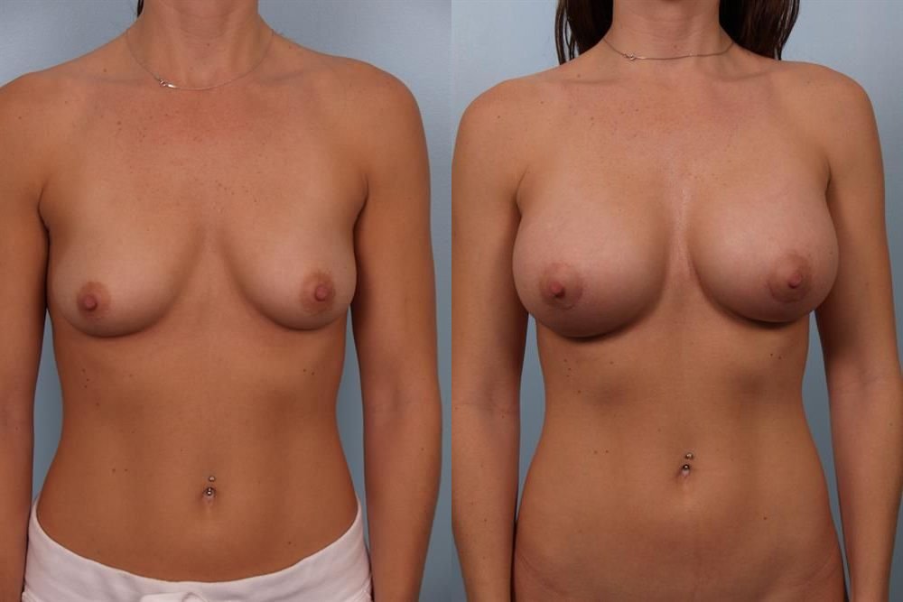 Breast Augmentation 263