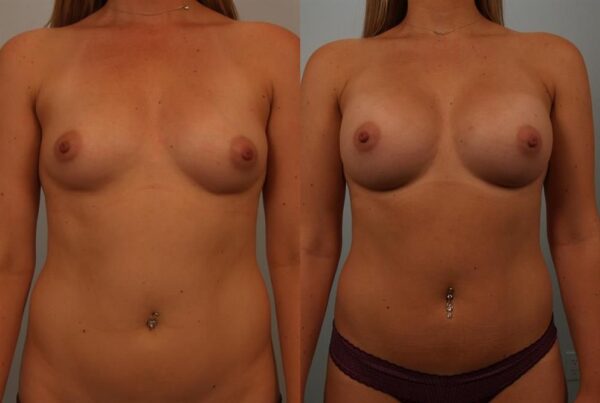 Breast Augmentation 265