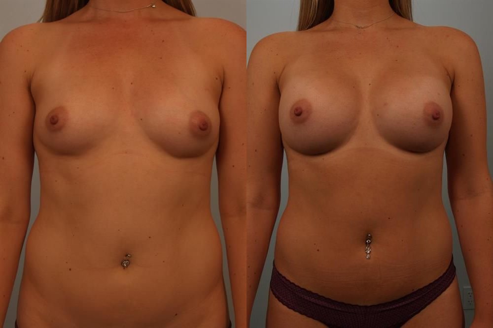 Breast Augmentation 265