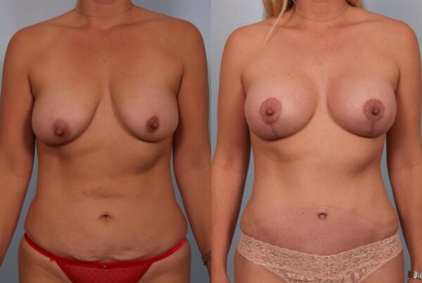 Breast Augmentation 266