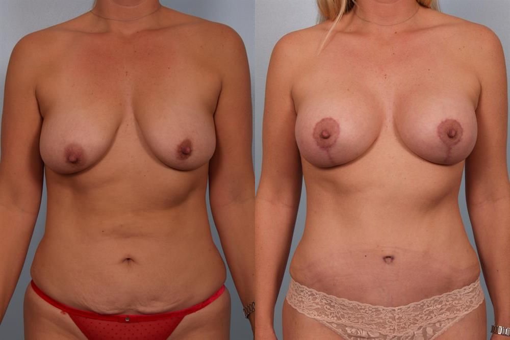 Breast Augmentation 266