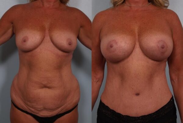Breast Augmentation 267