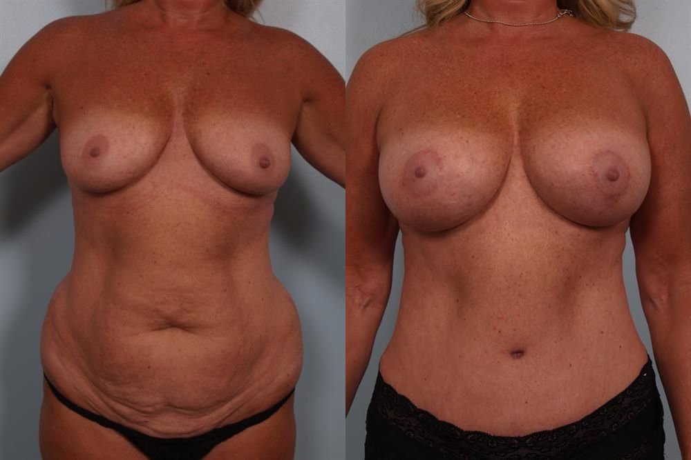 Breast Augmentation 267