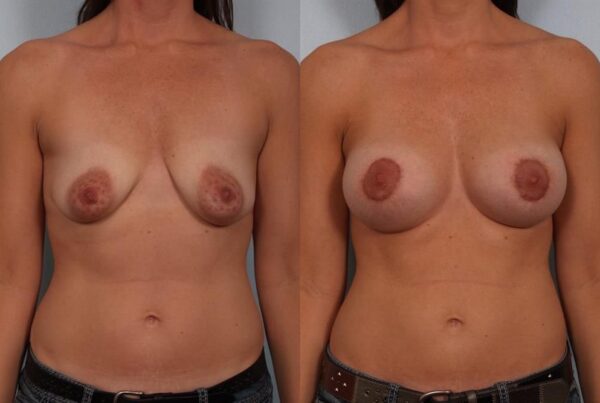 Breast Augmentation 268