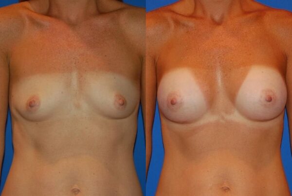 Breast Augmentation 269