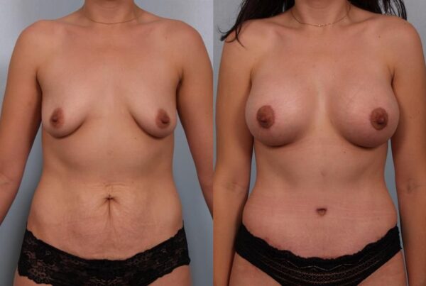 Breast Augmentation 27