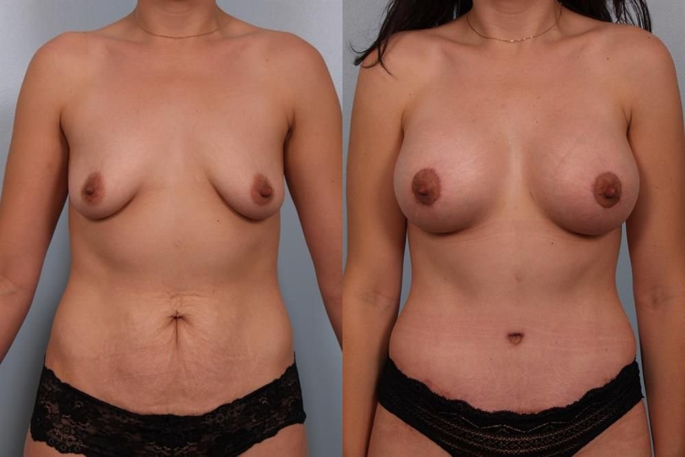 Breast Augmentation 27