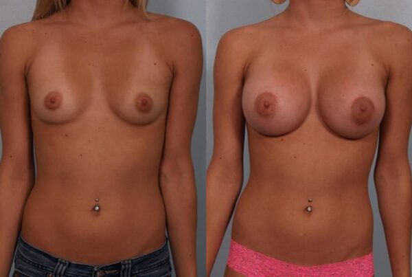 Breast Augmentation 270