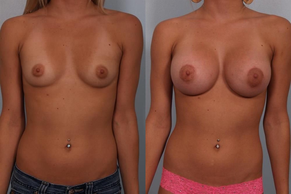 Breast Augmentation 270