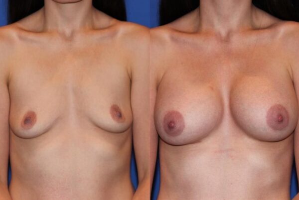 Breast Augmentation 271